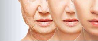 注射祛除皱纹对什么皱纹有效?