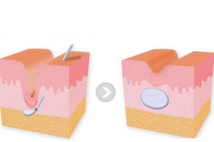 注射祛除皱纹对什么皱纹有效?