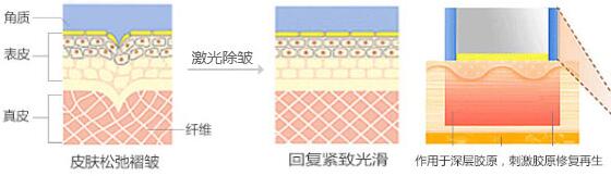 南京激光去皱可以维持多久?