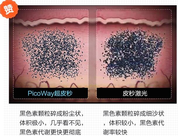 祛斑用医美激光祛斑技术真的好吗