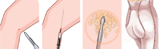 ��֬������Ŀ���ʹС������ȥ��?