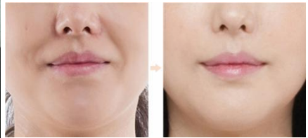 南京注射玻尿酸去法令纹的价格?