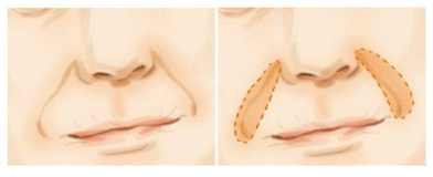 南京注射玻尿酸去法令纹的价格?