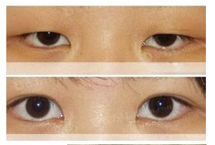 眼部的眼睑下垂和眼睑浮肿是一回事吗?