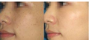 南京去雀斑多少钱?