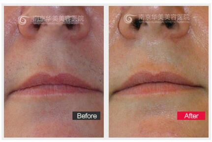 手术去除唇毛价格贵吗?