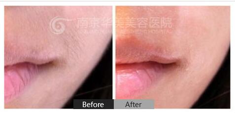南京冰点脱唇毛效果怎么样?
