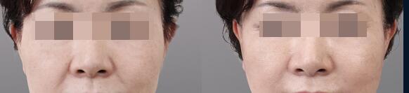 注射**除皱有禁忌吗?