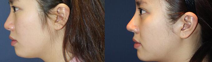 南京华美医院做综合隆鼻效果好吗?