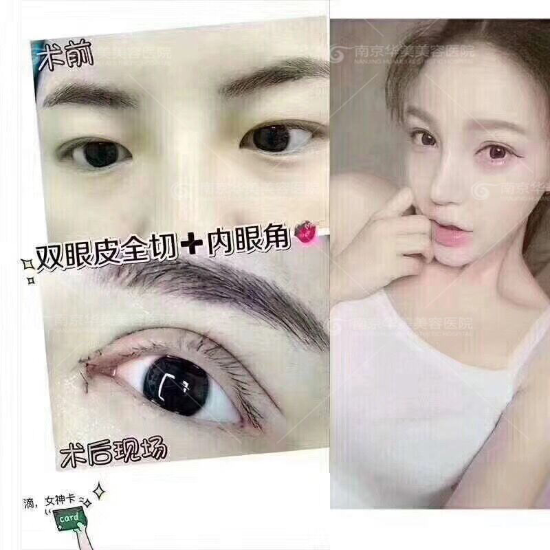 南京内双割双眼皮效果如何呢?