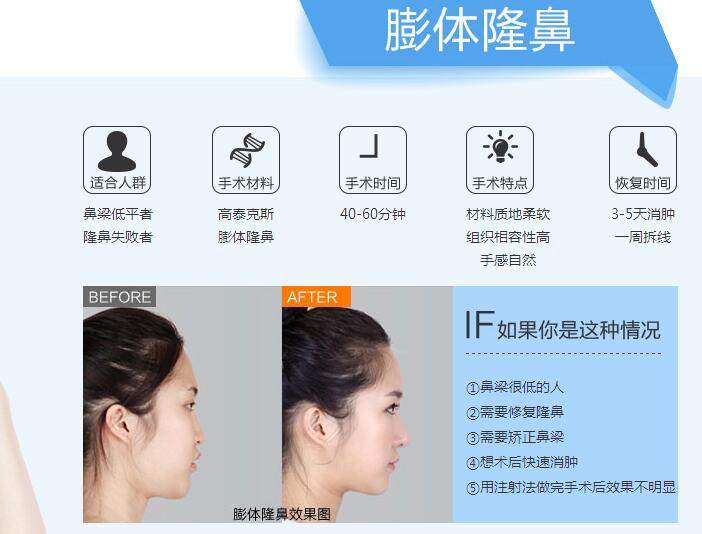 膨体隆鼻