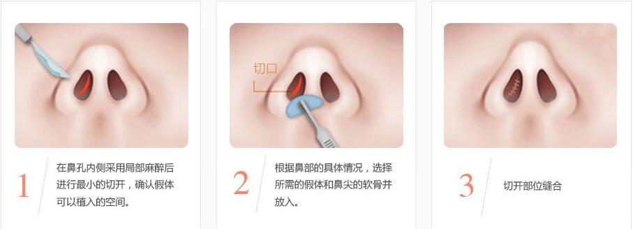 南京做隆鼻手术的风险高吗?