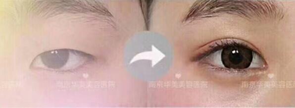 南京做重睑术安全性高吗?