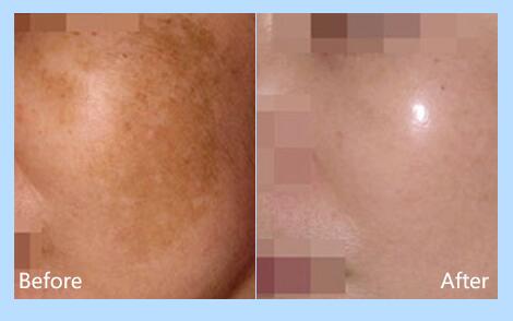 南京面部有黄褐斑可以治疗好吗?