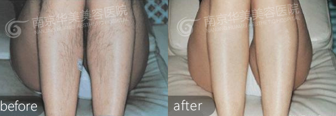 南京怎么祛腿毛效果长久呢