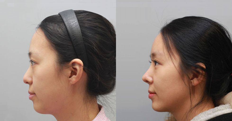 南京做假体隆鼻手术会出现后遗症吗