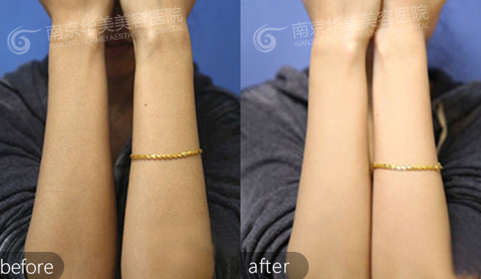 脱毛价格的影响因素有哪些